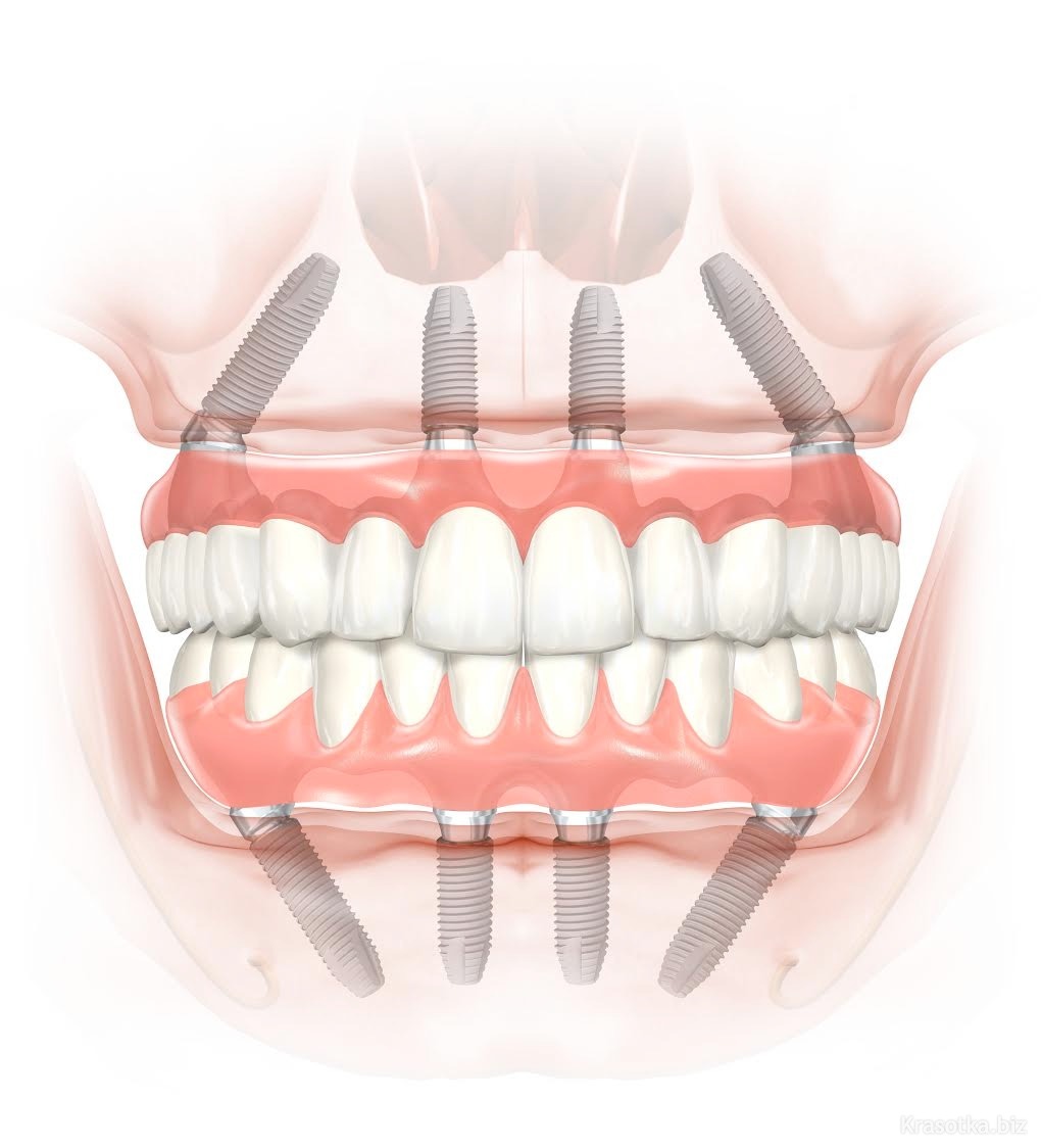 Зубные протезы. Все на 4 имплантах