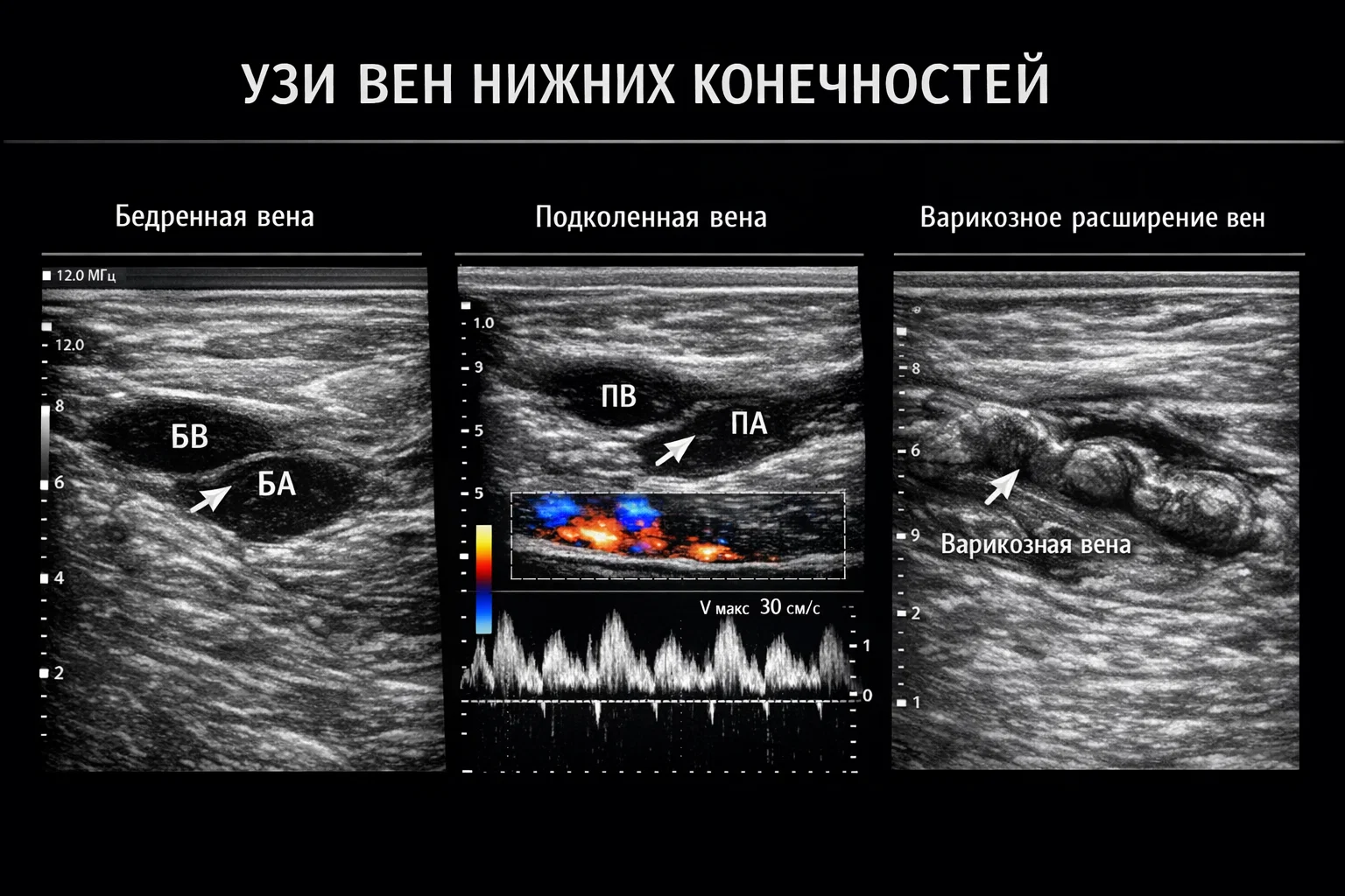 УЗИ вен нижних конечностей УЗИ вен нижних конечностей