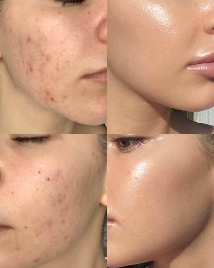 Лечение акне и угревой сыпи Лечение акне и угревой сыпи